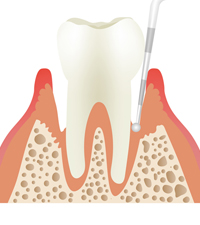 歯周病治療